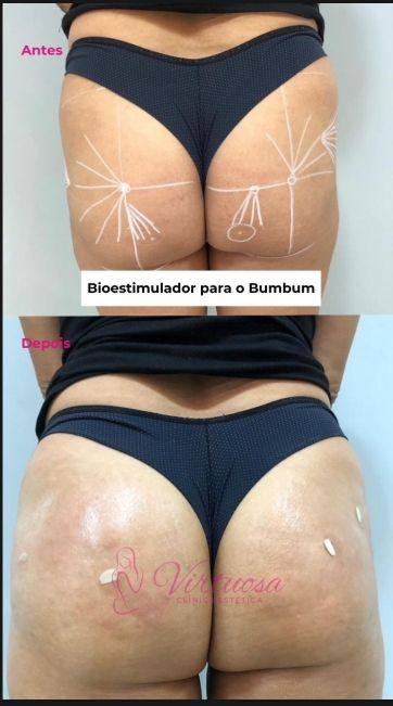 Resultado Bioestimulador de Glúteo