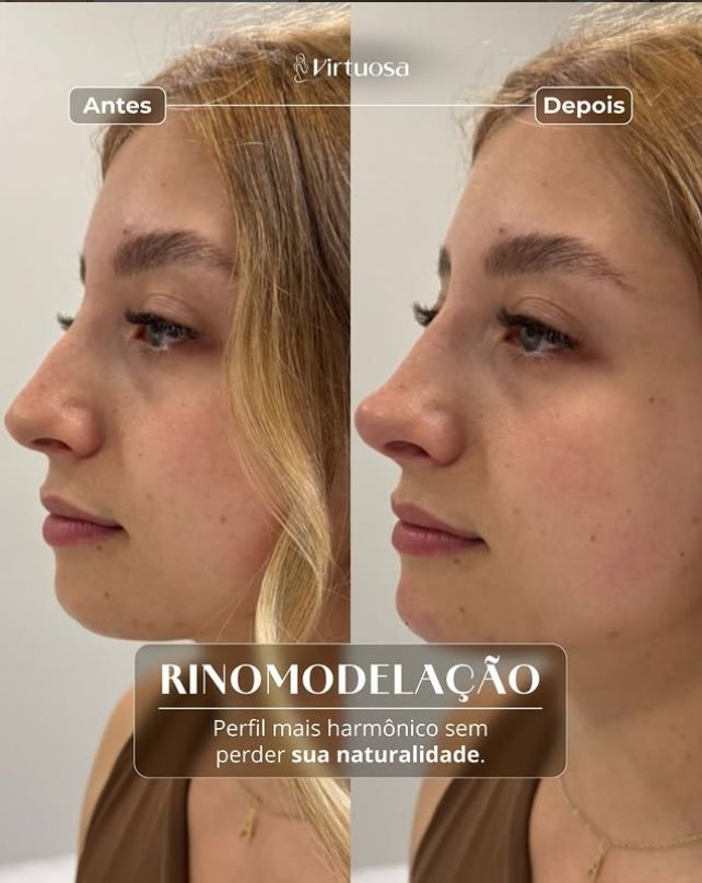 Resultado Rinomodelação