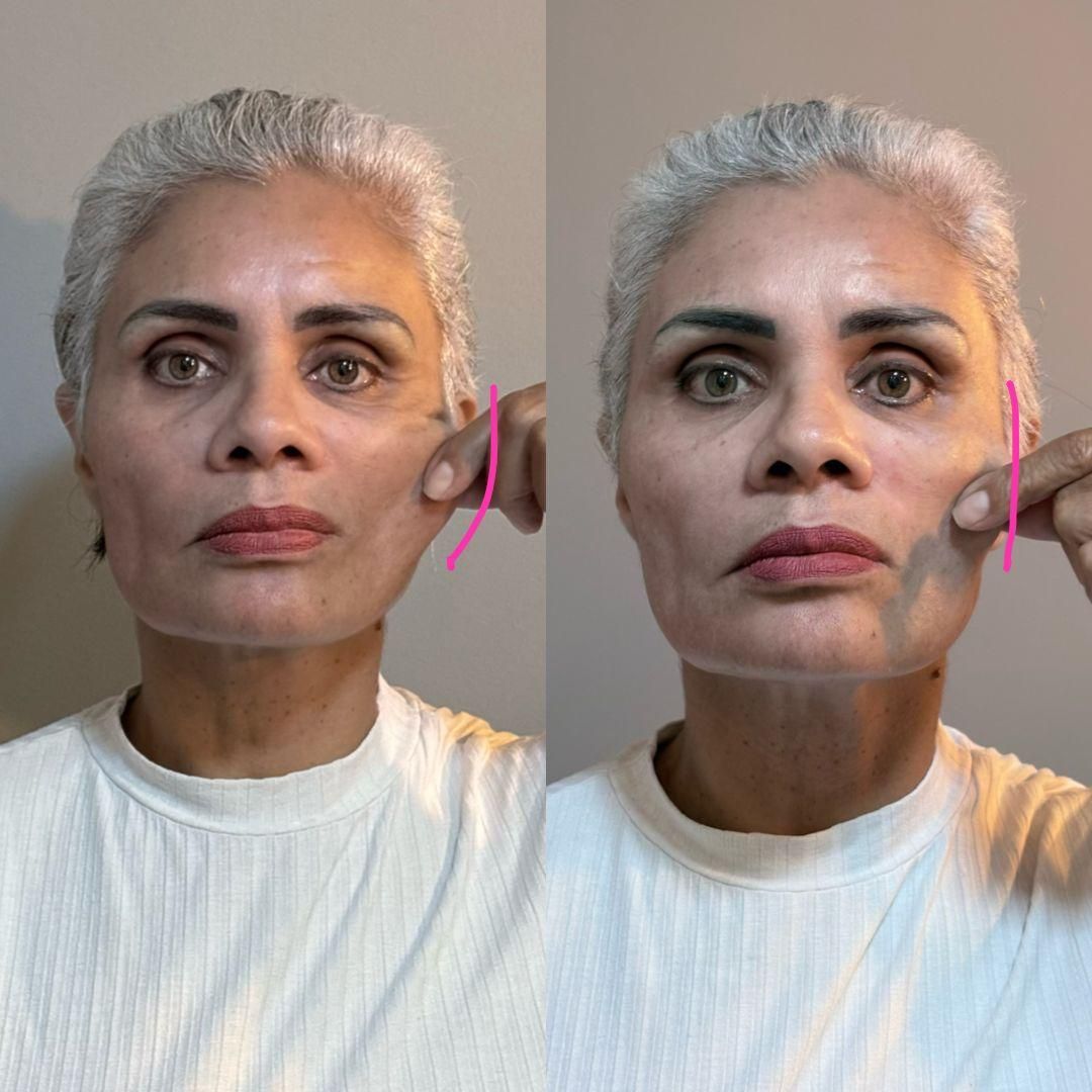 Resultado Lifting Facial