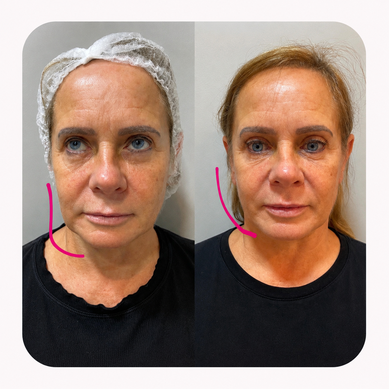 Resultado Rejuvenescimento