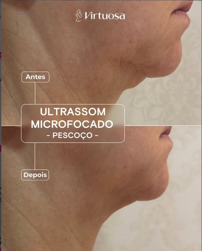 Resultado Ultrassom Microfocado