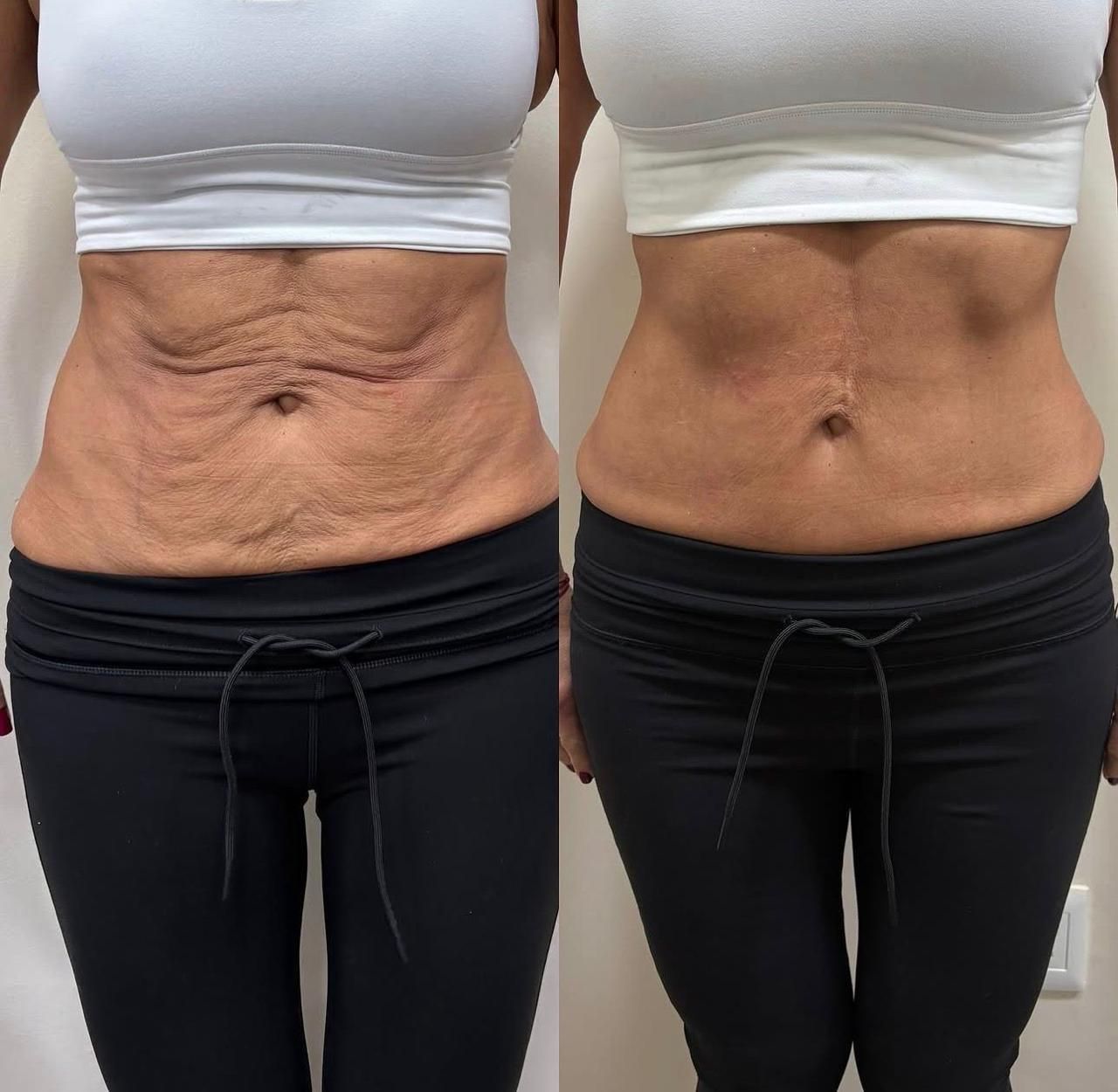 Resultado Abdominais