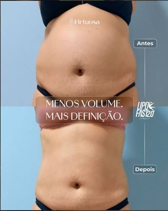 Resultado Lipo Fast