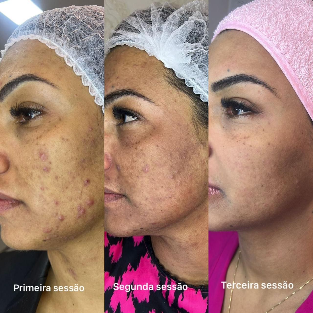 Resultado Melasma